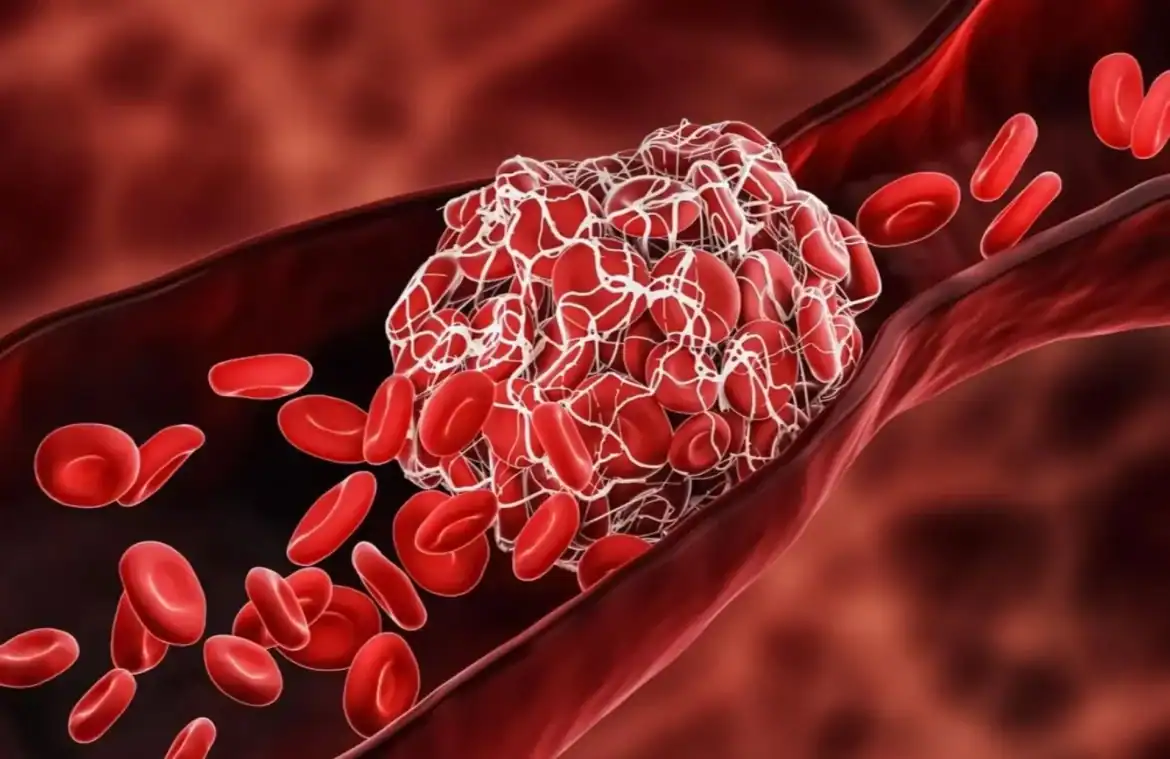 أفضل 3 أطعمة تسبب الجلطات الدموية وكيفية تجنب مخاطرها
